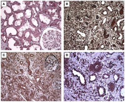 The Invisible Threat of Non-steroidal Anti-inflammatory Drugs for Kidneys